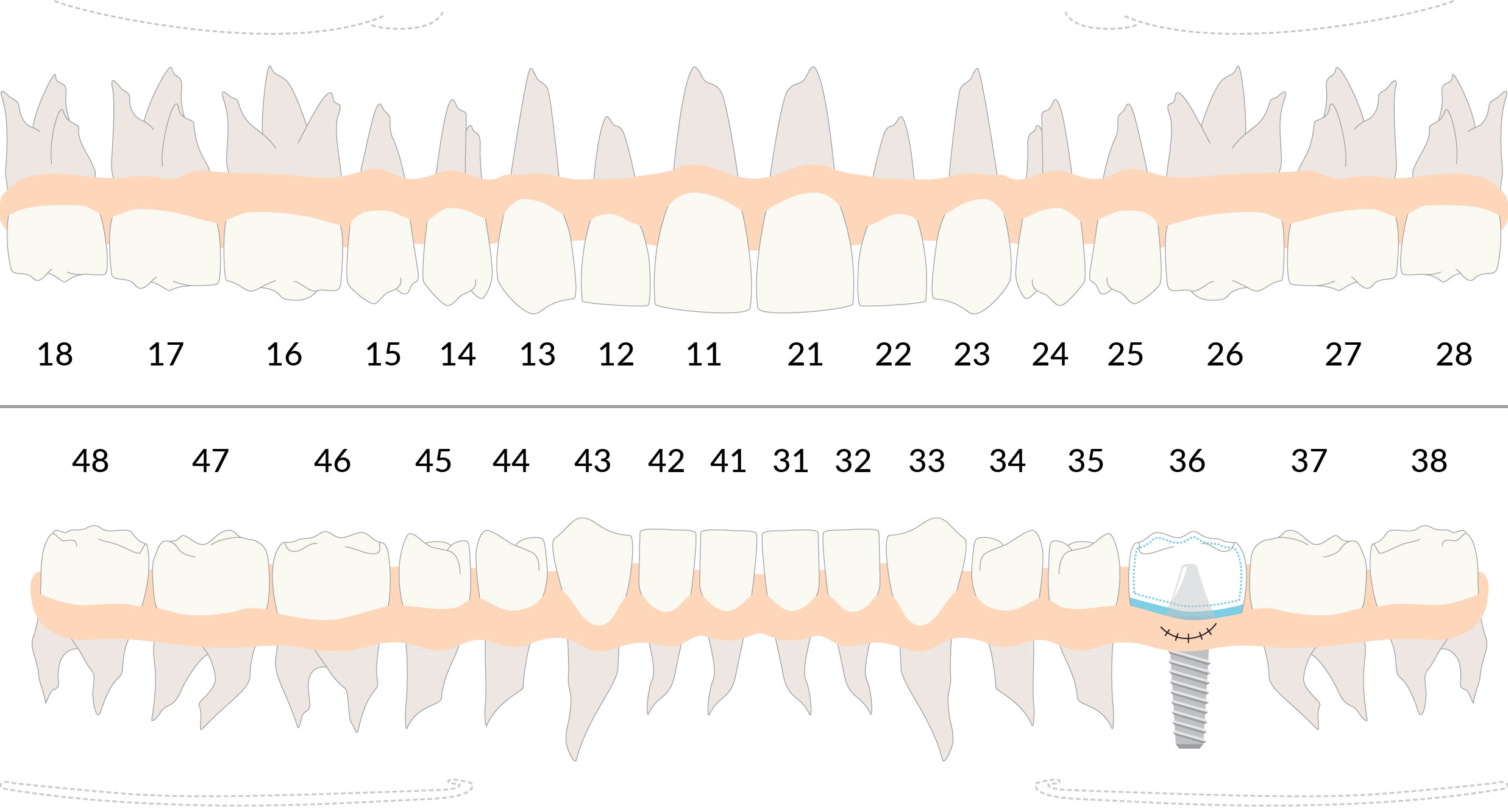 Piani di trattamento Impianto Semplice sul software per dentisti DentalOpera