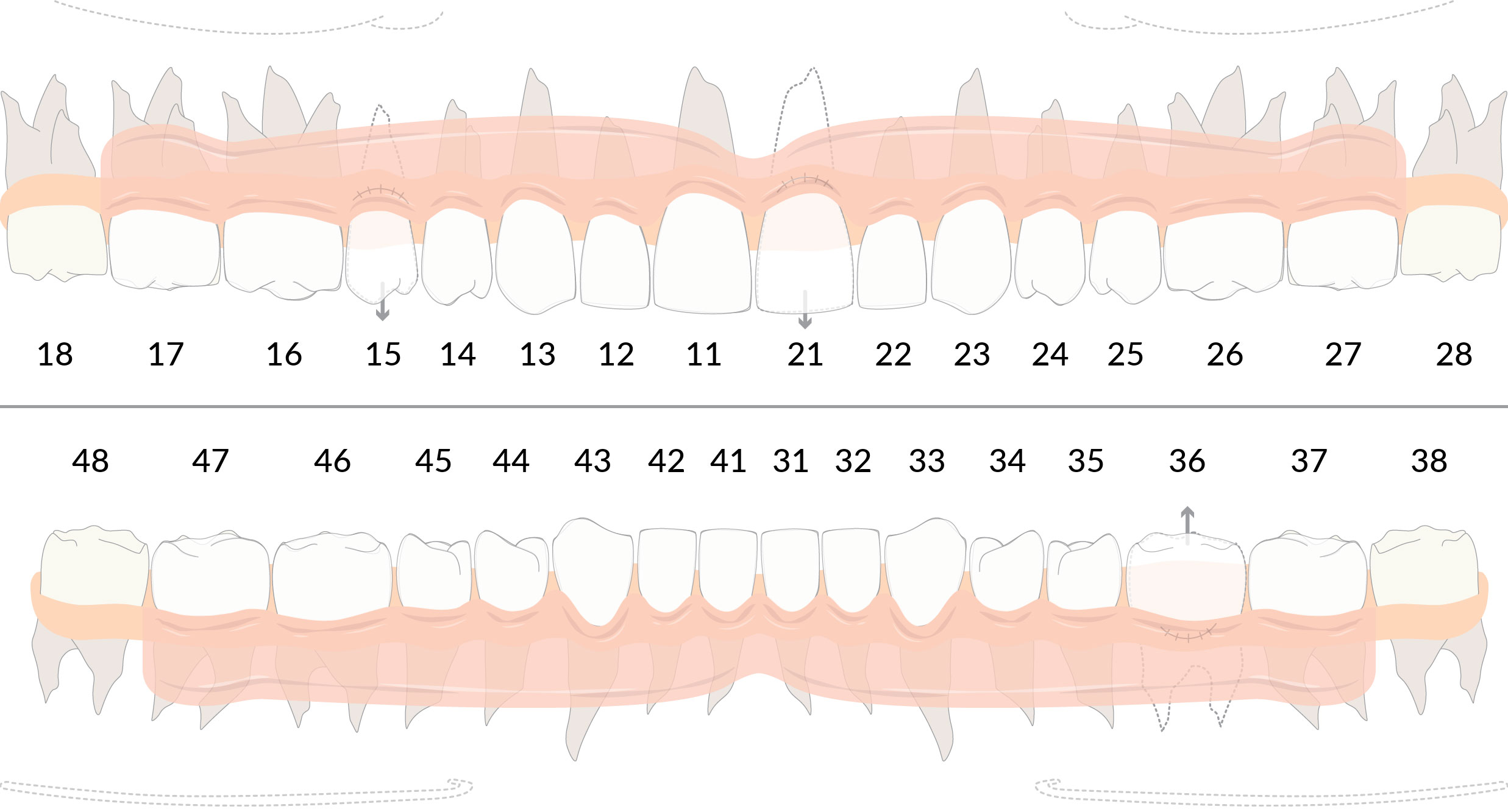 piano di trattamento di protesi mobile sul software per dentisti DentalOpera