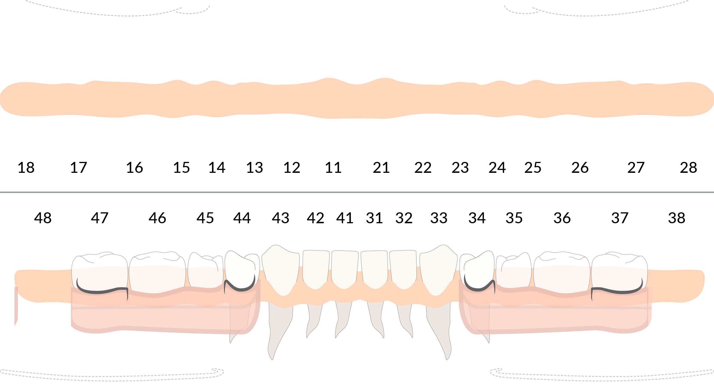 piano di trattamento di protesi scheletrata sul software per dentisti DentalOpera